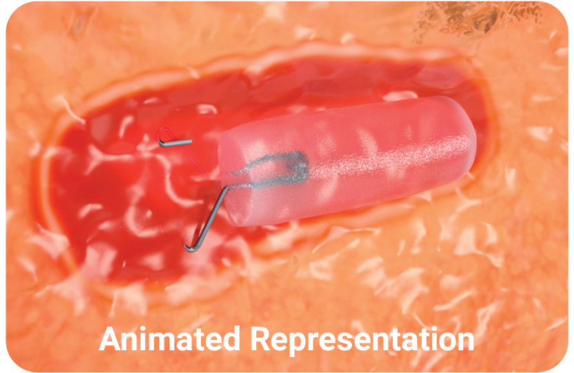 Animated representation of HydroMARK Plus marker in tissue