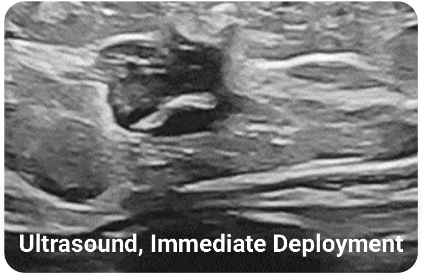 HydroMARK Plus immediate deployment under ultrasound